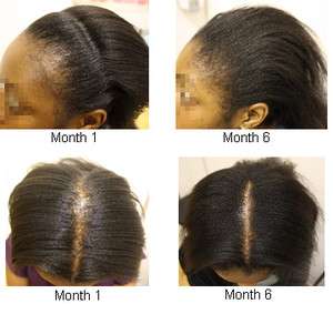 REJUVENATE POTENT JAMAICAN BLACK CASTOR OIL for Traction Alopecia 8oz 