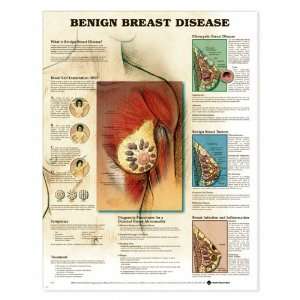  Chart   Benign Breast Disease Industrial & Scientific